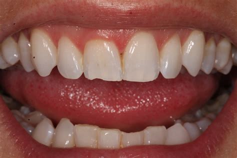 White Tooth Fillings Dental And Composite Bonding Treatments London