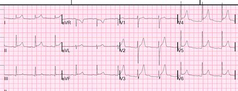 Dr Smith S Ecg Blog Increasing St Elevation Stemi Vs Dynamic Early