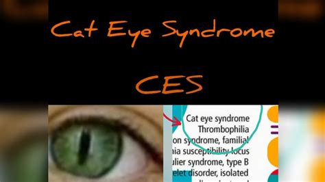 Cat Eye Syndrome Ces Chromosome 22 Aberration In English Youtube