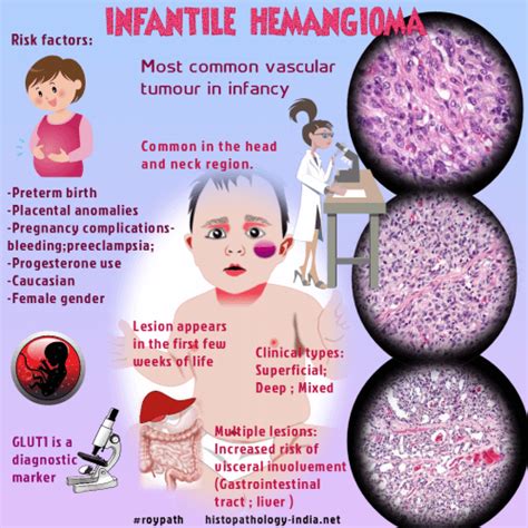 Pathology Of Infantile Hemangioma Juvenile Hemangioma Cellular