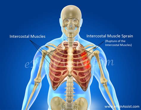 Rib Cage Muscles Upper Back Pain From Intercostal Mus