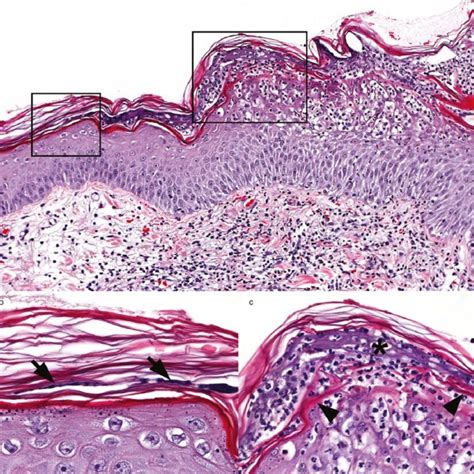 Canine Epidermal Collarettes Clinical Lesions Acd Annular To