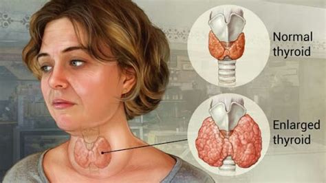 Goiter What It Is Causes Symptoms Diagnosis And Treatment