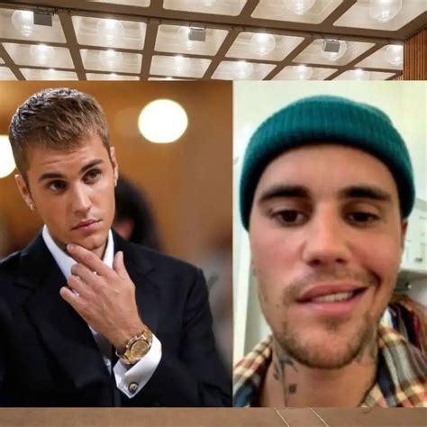 What Is Ramsay Hunt Syndrome Affecting Justin Bieber