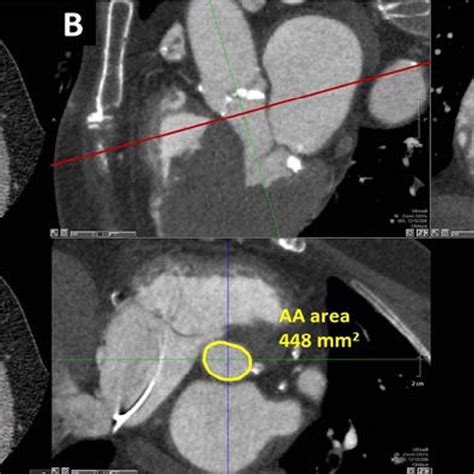 Multidetector Row Computed Tomography Of The Aortic Root A Aortic