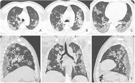 Chest Ct Shows Covid 19 Damage To The Lungs