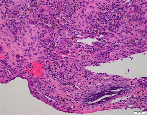 Pathology Outlines Aneurysmal Bone Cyst