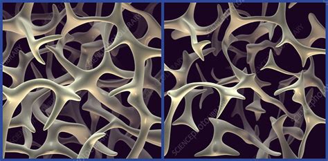 Trabecular Bone Stock Image M2300530 Science Photo Library