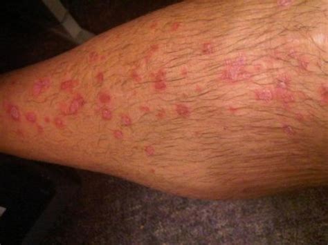 Psoriasis Or Eczema From The Pictures Psoriasis Inspire
