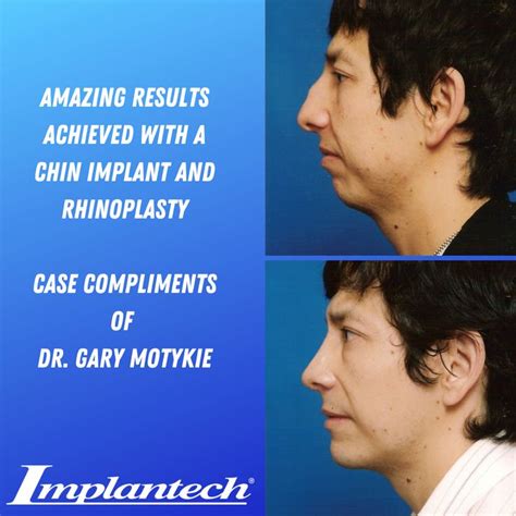 Check Out The Amazing Results Dr Gary Motykie Achieved With A Chin