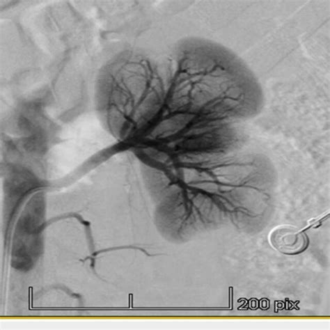 Renal Angiogram Showing No Areas Of Stenosis In The Left Renal Artery