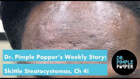 Dr Pimple Poppers Weekly Story Skittle Steatocystomas Chapter 4
