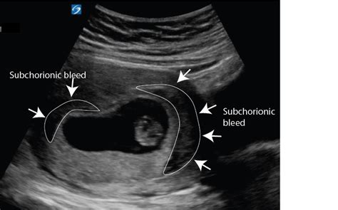 Subchorionic Bleed10 Week Pregnancy Critical Care Sonography
