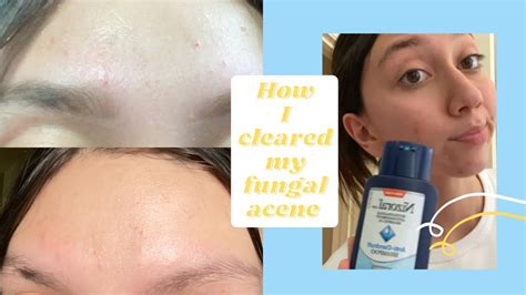 How I Cleared My Fungal Acne Using Nizoral Anti Dandruff Shampoo