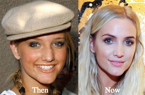Ashlee Simpson Plastic Surgery Before And After Photos