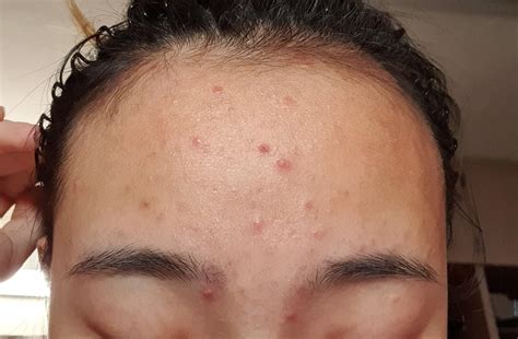 Acne Need Tips And Product Recommendations For Acne Usually Cystic In