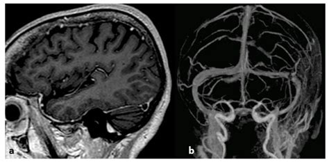 Life Free Full Text Imaging Of Cerebral Venous Thrombosis