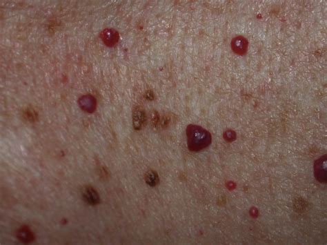 Little Red Spots On Skin
