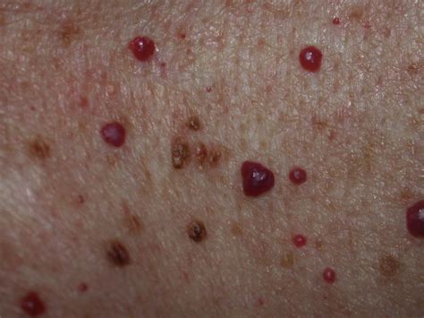 If you have cherry angiomas, you might try some cherry angioma home remedies. Cherry angioma: Symptoms, causes, and treatment