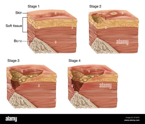 Illustration Showing The 4 Stages Of A Bedsore Or Pressure Sore