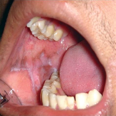 Reticular Oral Lichen Planus Of The Posterior Right Buccal Mucosa With