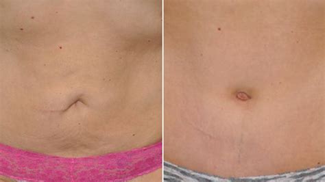 Belly Button Makeovers Computers Help Define The Perfect Navel