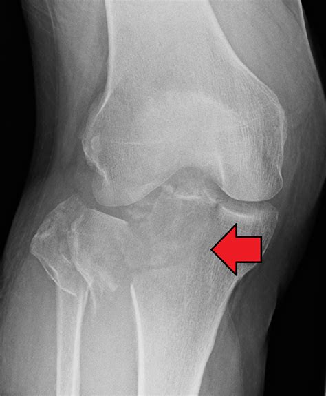 Tibial Plateau Fracture Discover The Latest In Tibial Plateau