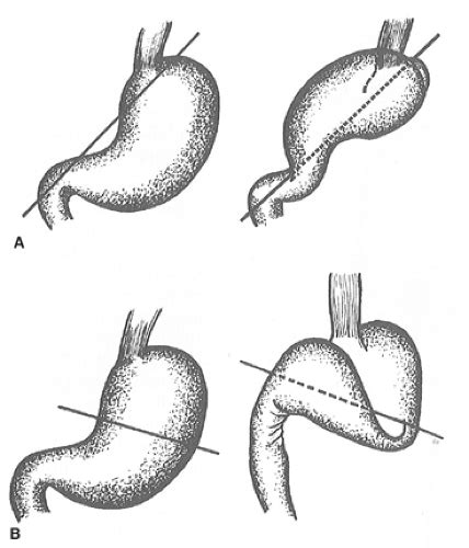 Paraesophageal Hernia With Gastric Volvulus