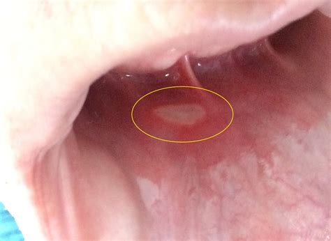 Aphthous Ulcers