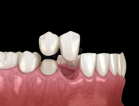 Cantilever Bridge Made From Ceramic Frontal Tooth Recovery Medically
