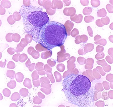 Acute Monocytic Leukemia 4