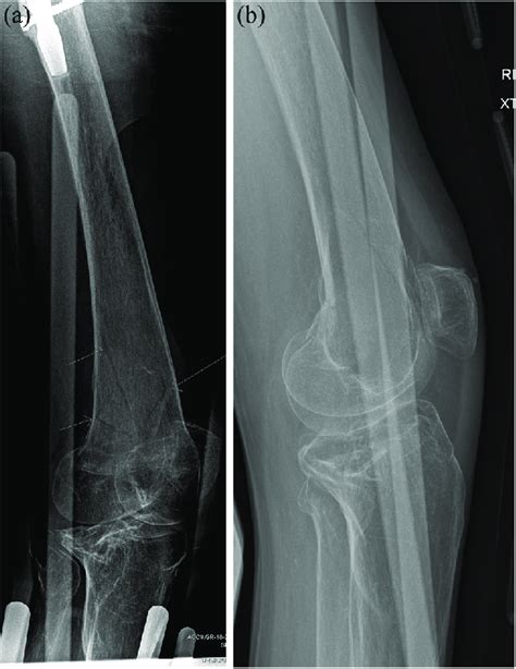 A Oblique Of Right Nondisplaced Distal Femur Fracture Preop B