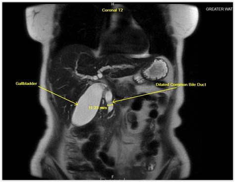 magnetic resonance cholangiopancreatography mrcp gwic