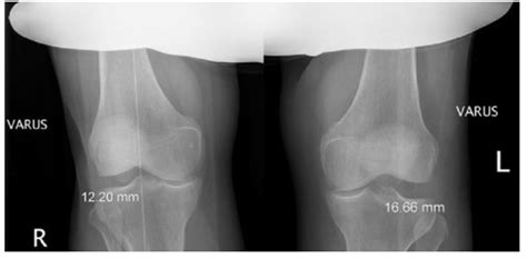 Stress Radiographs Of The Knee Sports Medicine Review