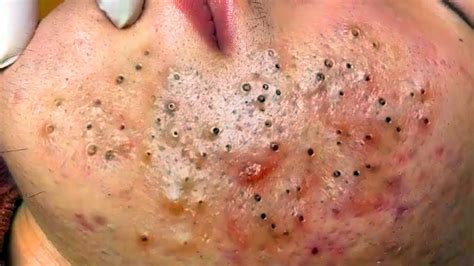 Relax Every Day Spa Popping Huge Blackheads And Pimple Popping