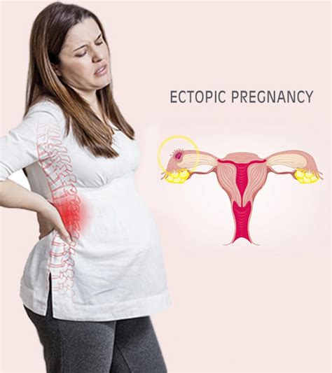 Something is always fishy about the fishes. Ectopic Pregnancy Meaning In Tamil