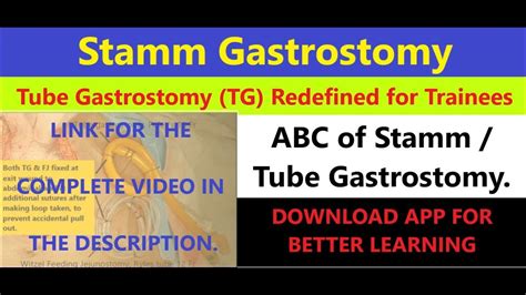 Stamm Gastrostomy Tube Gastrostomy Trailer Step By Step Complete