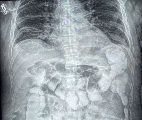 Upright Frontal Abdominal Radiograph Shows Contrast Filled Loops Of