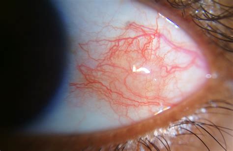 Episcleritis Eyewiki