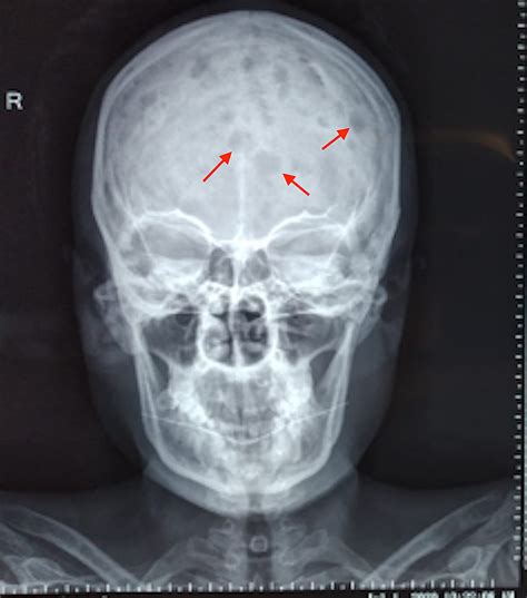 Clinical review and diagnostic imaging. Cureus | Far and Few Between: Early Onset Multiple Myeloma ...