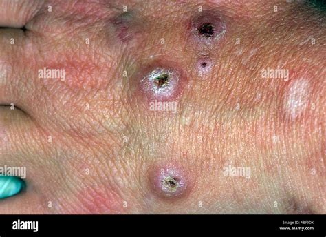 Skin Nodules Hi Res Stock Photography And Images Alamy