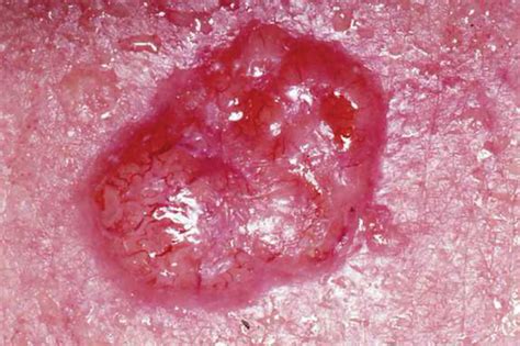 Basal Cell Carcinoma The Operative Review Of Surgery