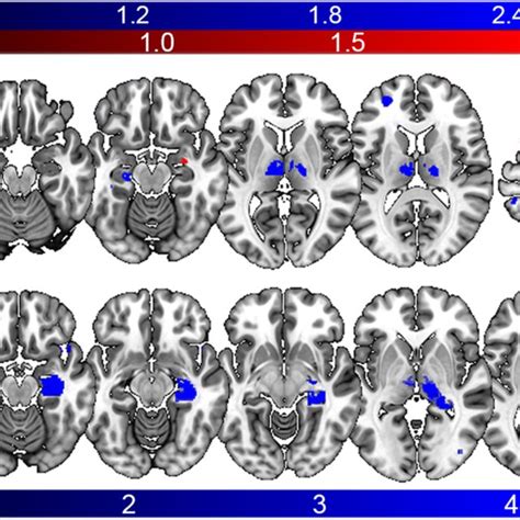 Structural Brain Remodeling In Temporal Lobe Epilepsy A Statistical