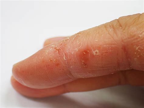 50 Shocking Facts Unveiling Eczemas Global Impact 2023