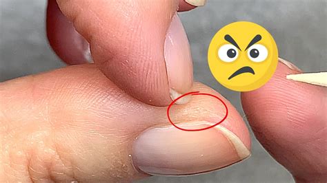 Hard Annoying Skin Around The Nails 2 Easy Solutions Youtube