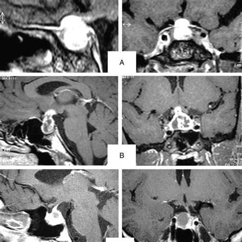 Preoperative Sagittal Right And Coronal Left T1 W Mr Images
