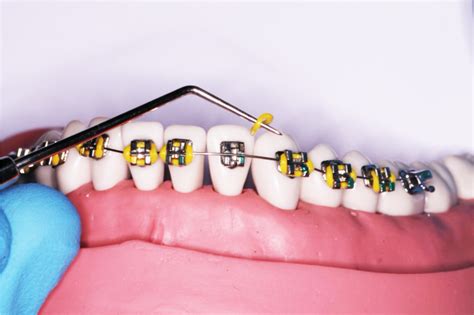 How To Get Nhs Orthodontic Treatment