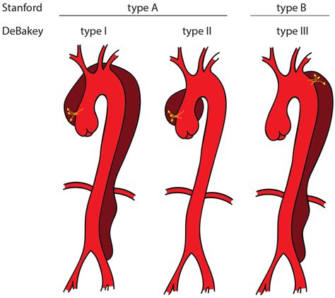 Acute Aortic Dissection Pathogenesis Risk Factors And Diagnosis