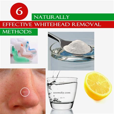 6 Natural And Most Effective White Head Removal Methods White Heads