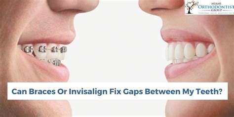 Can Braces Or Invisalign Fix Gaps Between My Teeth Miami Orthodontist Group